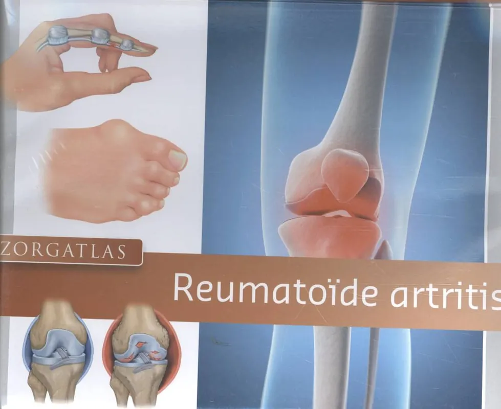 Bestel Nu Zorgatlas Reumatoïde artritis / Druk 1